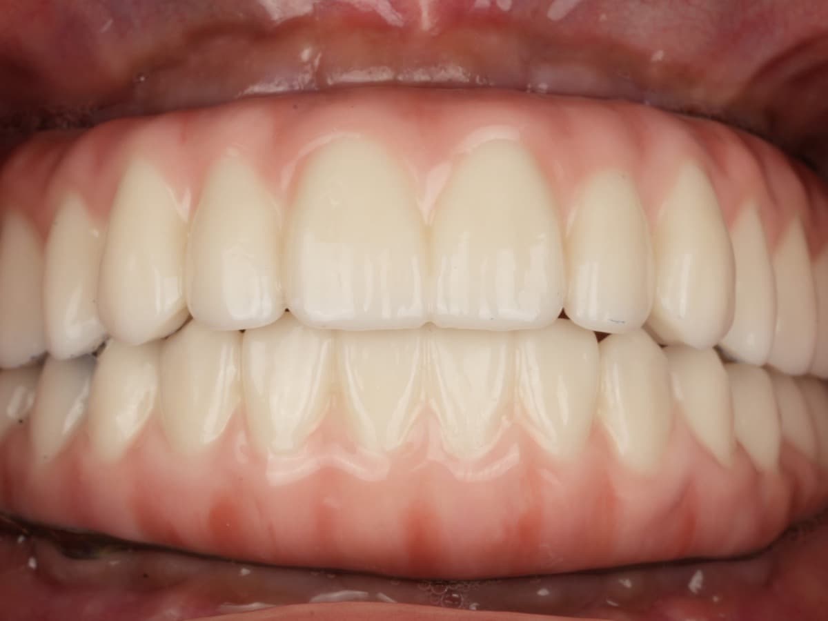 After treatment