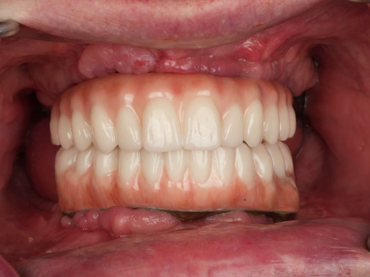 Fixed full-arch implant restoration, completed case