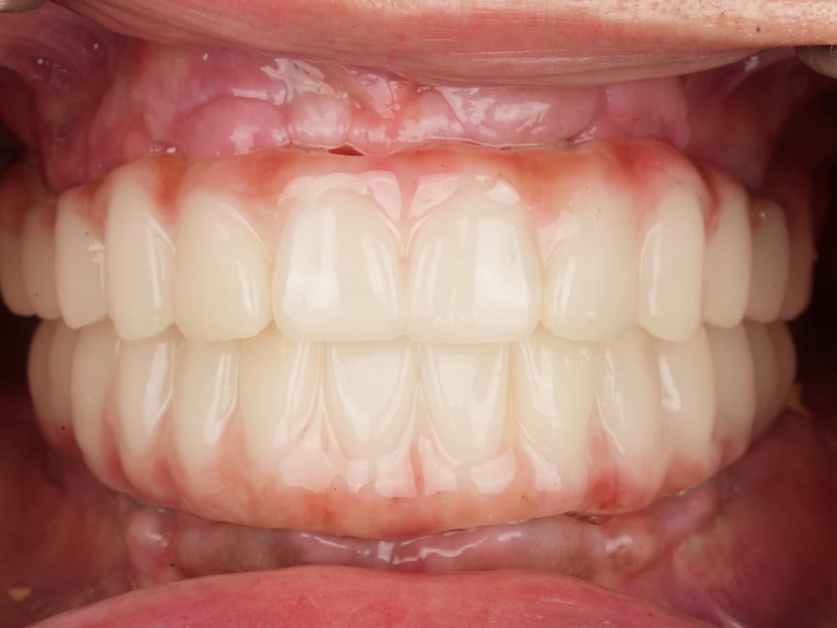 Full-arch implant-supported prosthesis outcome