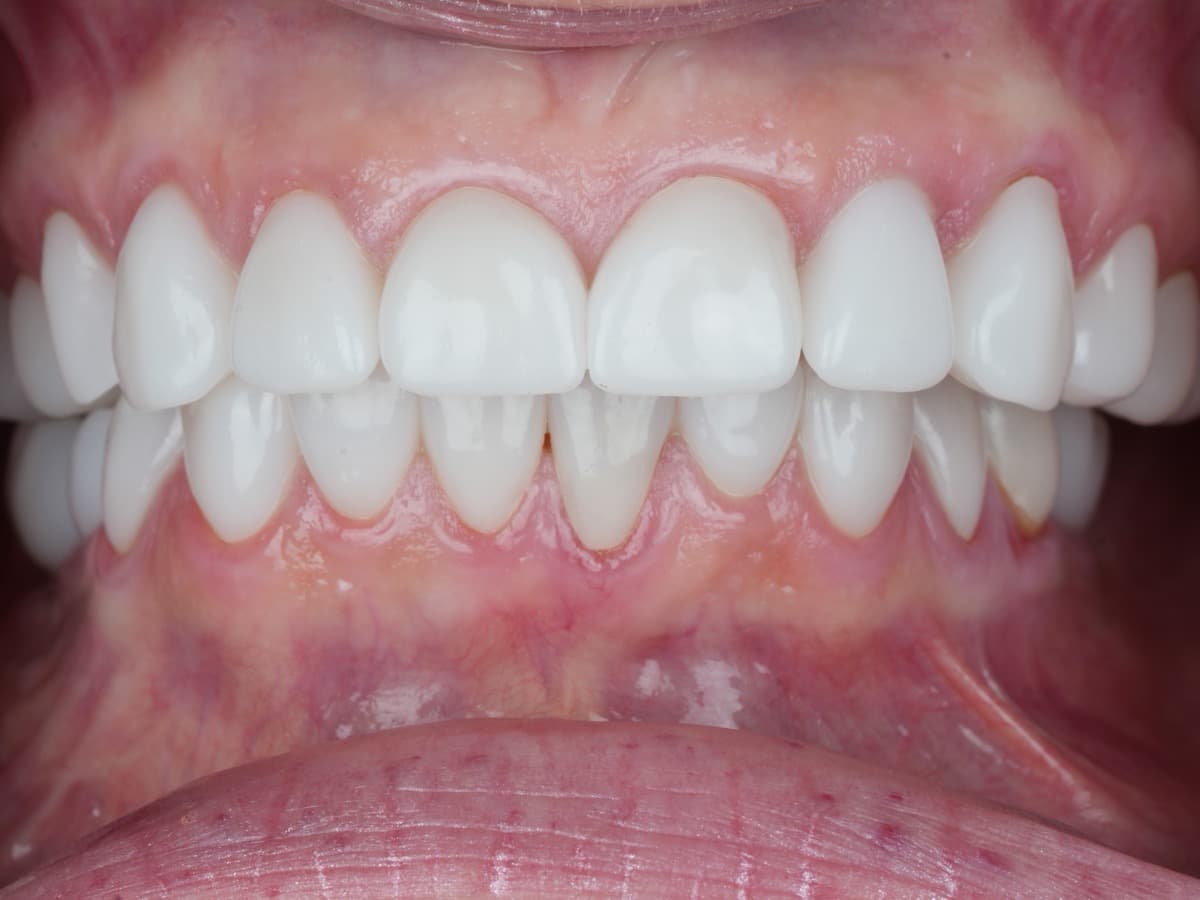 Fixed full-arch restoration, All-on-4 case