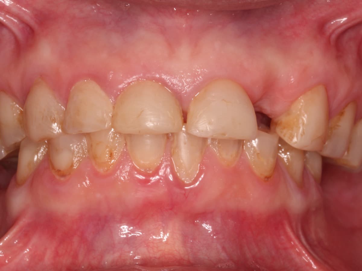 Before treatment