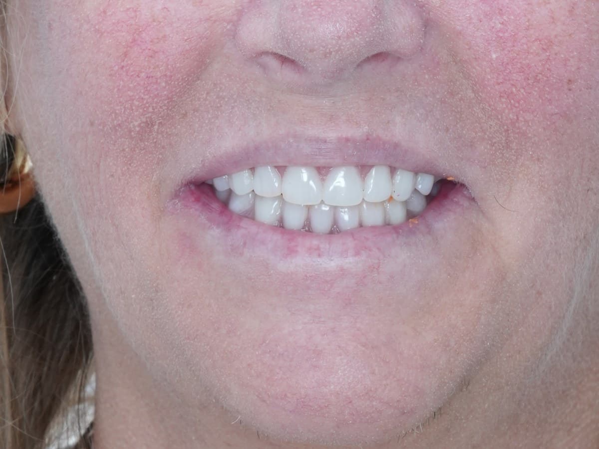Full-arch implant-supported fixed prosthesis