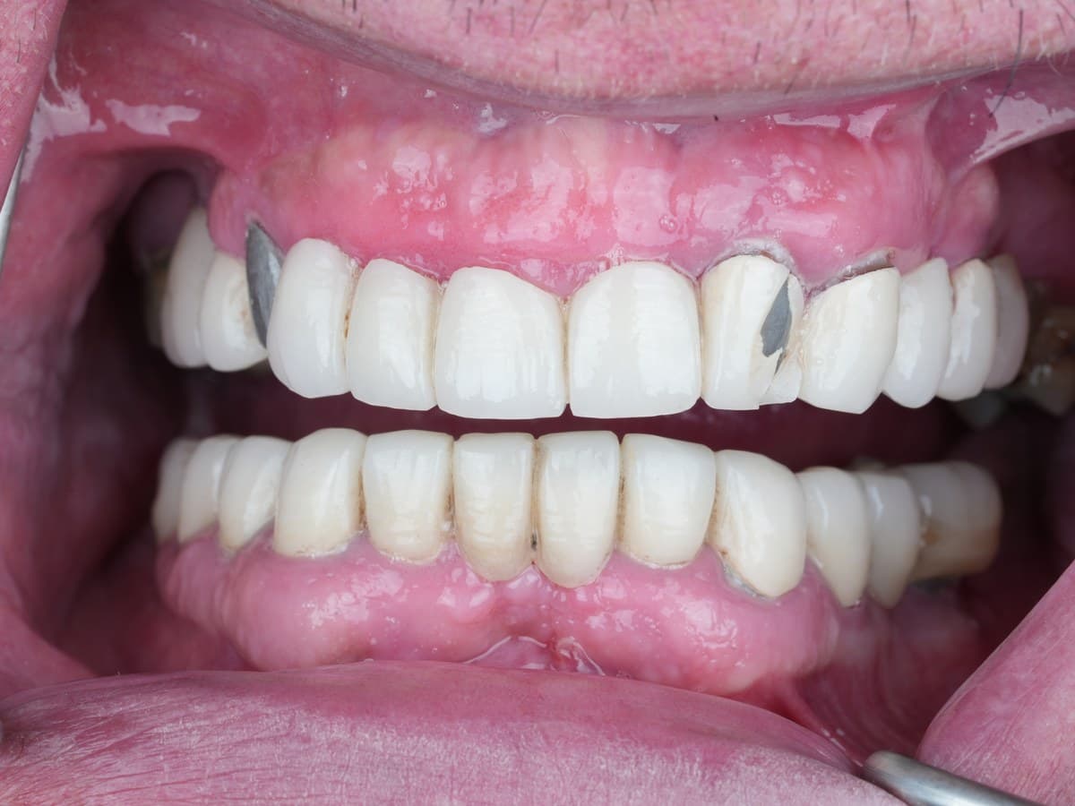 Full-arch implant case, before treatment