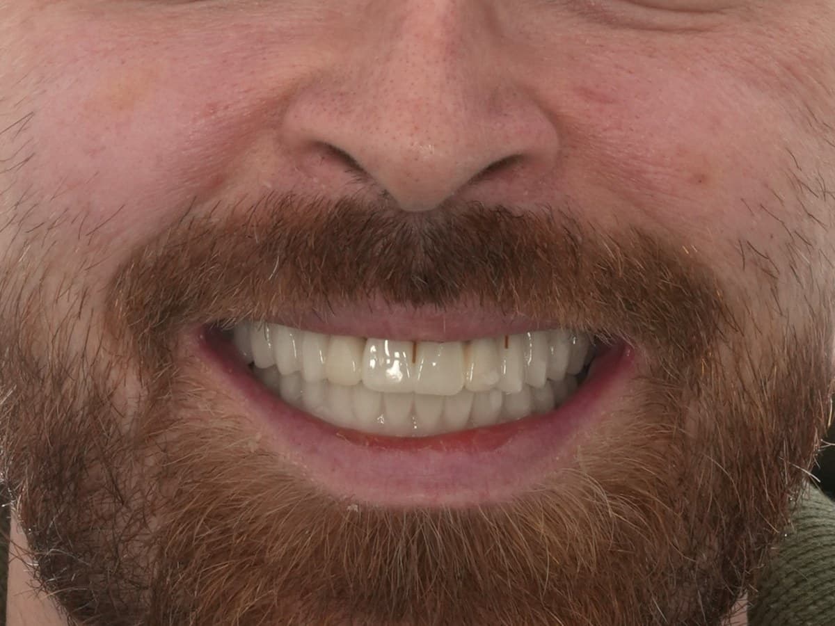 Full-arch implant rehabilitation, after implant placement